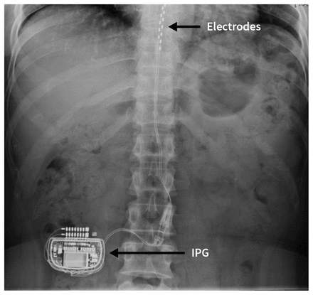 Chronic pain solution: Spinal cord stimulators (SCS) versus scrambler  therapy